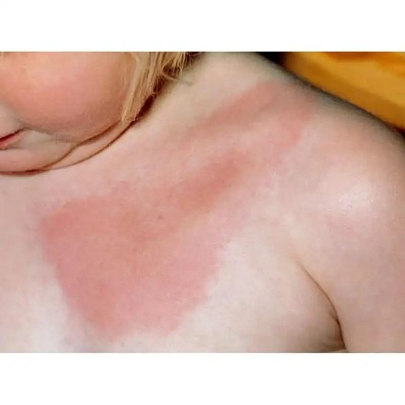 How to Diagnose & Treat Lyme Disease Naturally