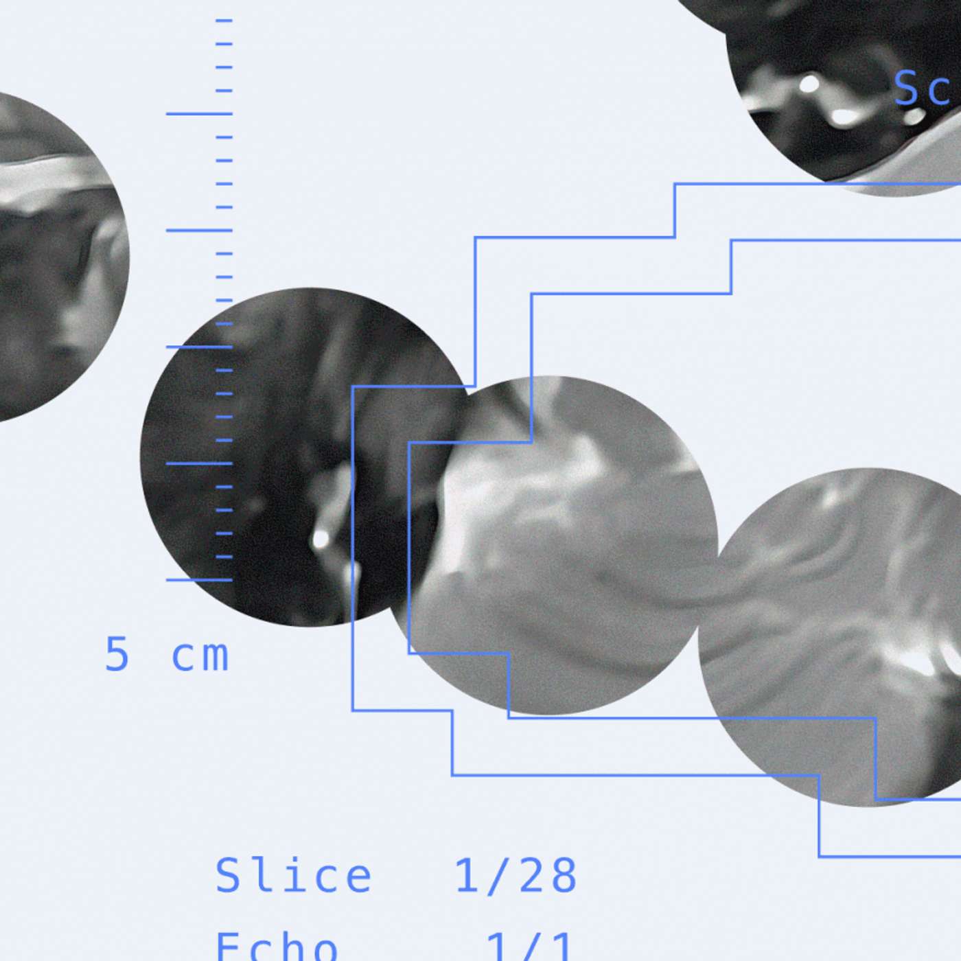 Researchers Develop AI to Spot Early Signs of Cerebral Palsy in Infants