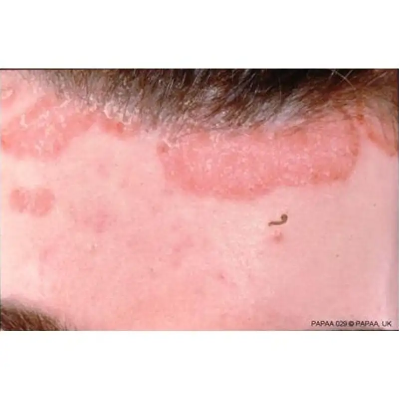 LifeWave Patching for Your Summer Skin:  Bug Bites, Rashes, Wrinkles & Sunburns