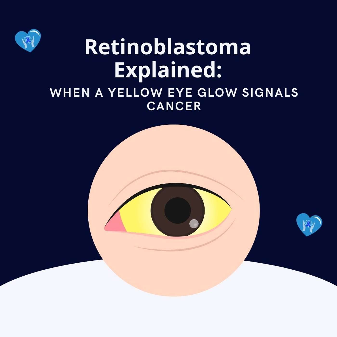 Retinoblastoma Explained: When a Yellow Eye Glow Signals Cancer