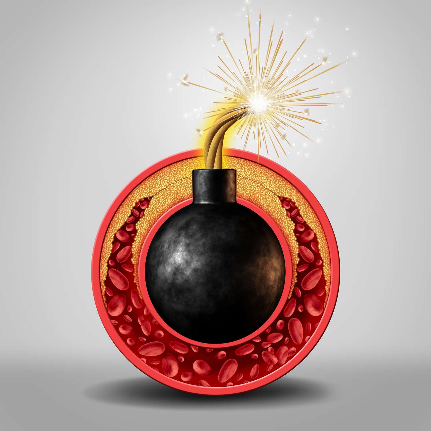 טרשת עורקים – סימני אזהרה ודרכי מניעה טרשת עורקים – סימני אזהרה ודרכי מניעה