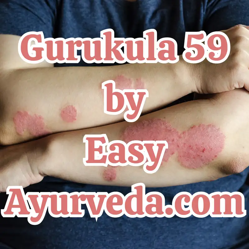 Gurukula 59: ”Healing Psoriasis through Ayurveda” 