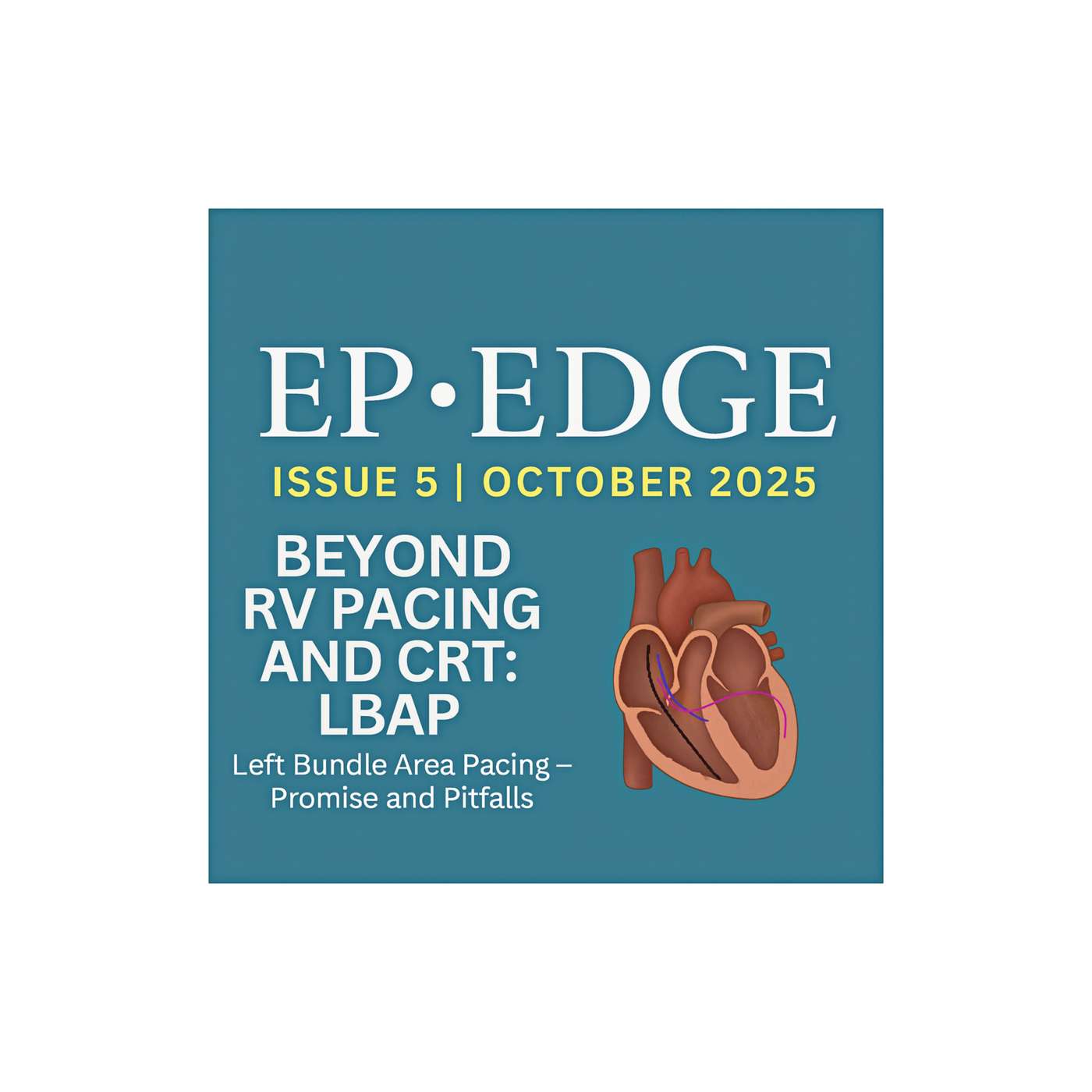 Beyond CRT: LBBAP and the New Era of Physiological Pacing — Promise and Pitfalls: EP Edge Newsletter October 2025 Issue 5 Beyond CRT: LBBAP and the New Era of Physiological Pacing — Promise and Pitfalls: EP Edge Newsletter October 2025 Issue 5